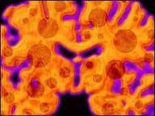 alzheimer brain