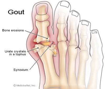 Gout 20101116104850